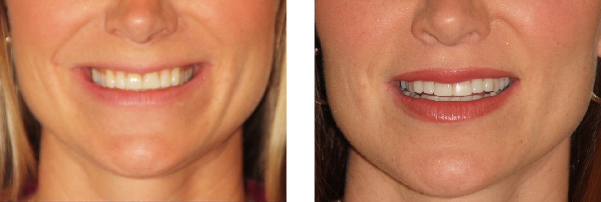 Side-by-side comparison of a person's smile before and after orthodontic treatment.