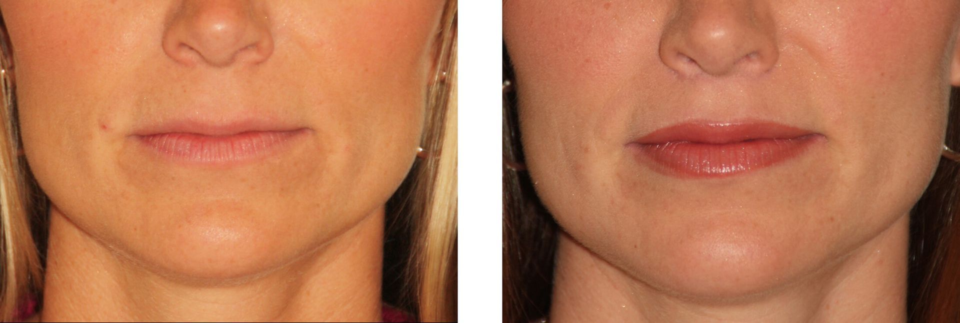 Before and after photos of a person's lower face and lips; the after photo shows fuller lips.