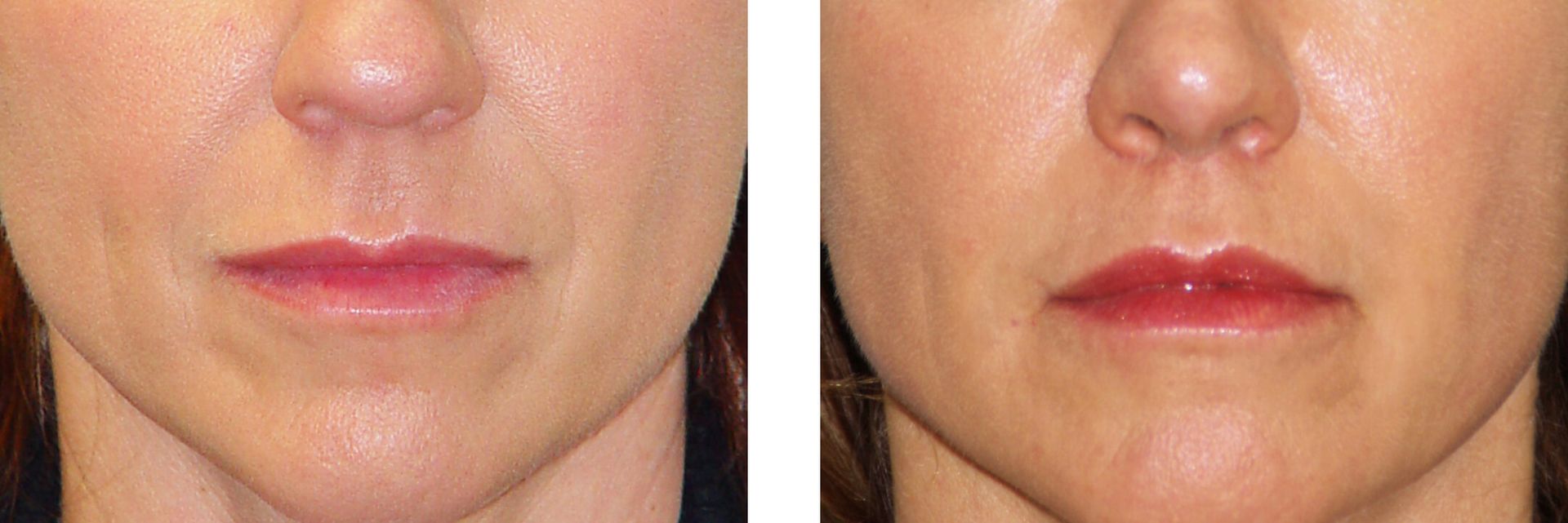 Before and after photo of a person's face. The lips look fuller and more defined in the after photo.
