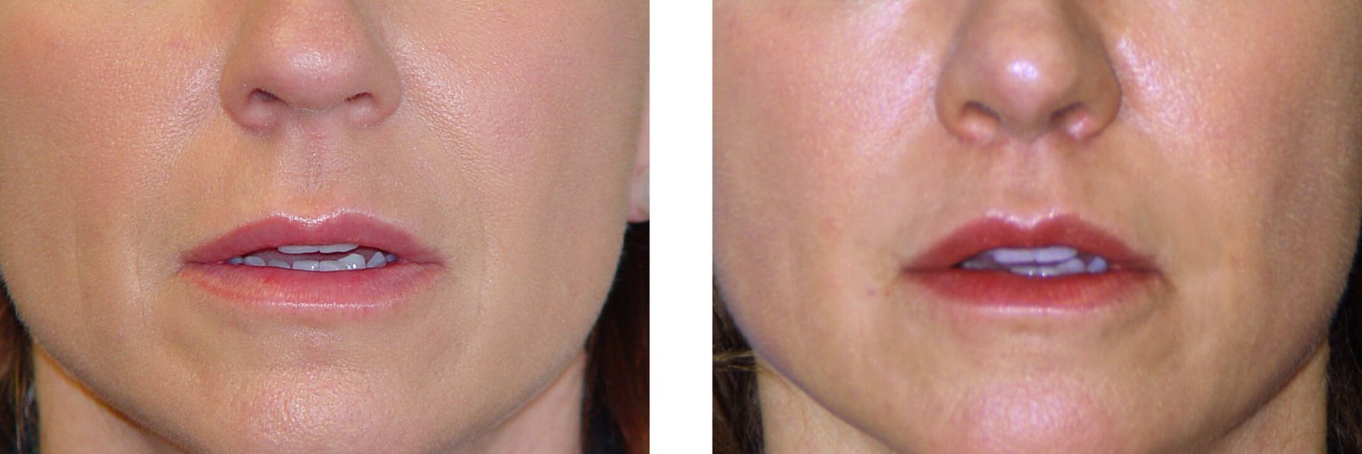 Two close-up views of a person's mouth and nose. The lips appear fuller in the right image compared to the left.