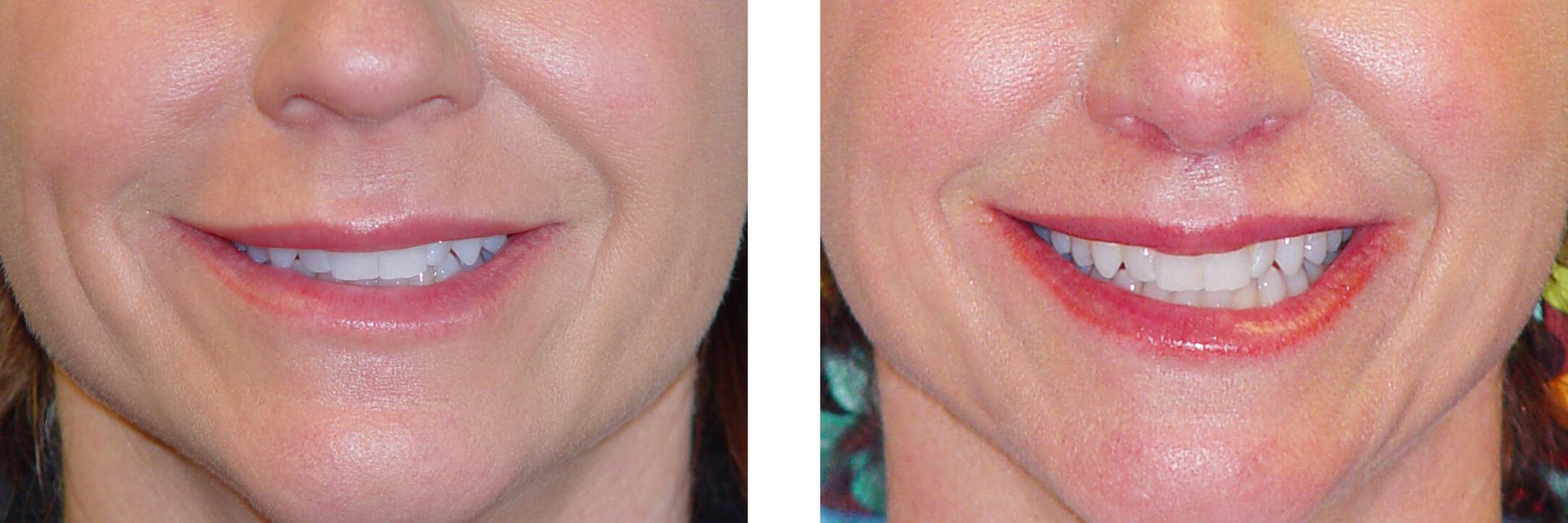 Comparison of two smiling mouths; the one on the right appears to have had cosmetic work done.