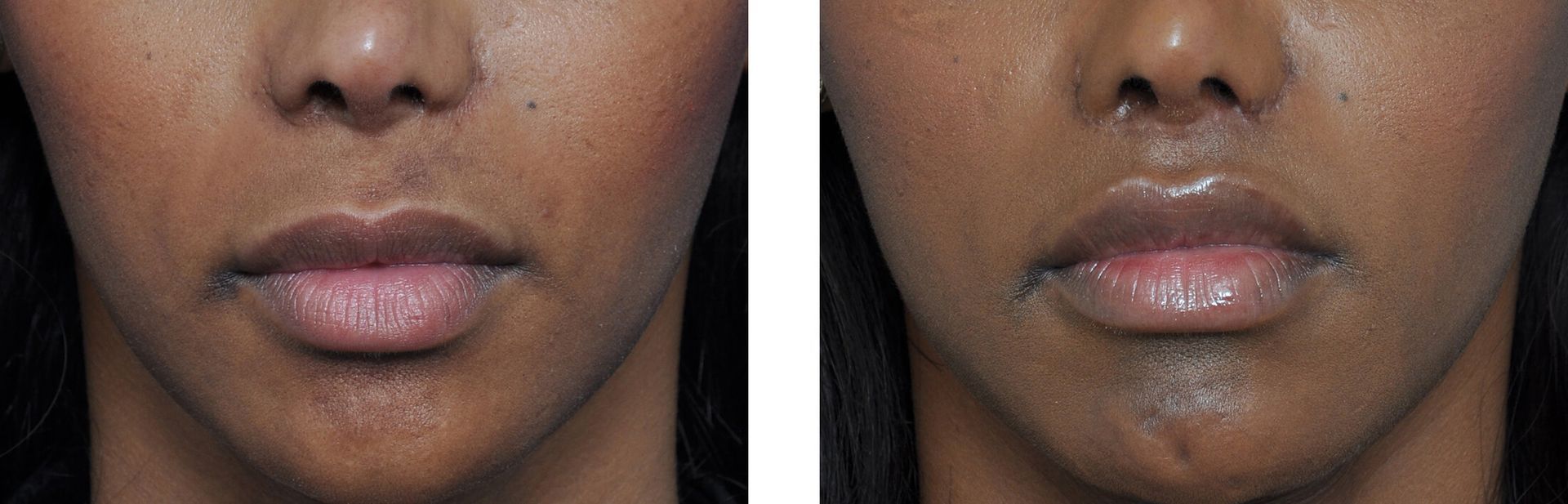 Two side-by-side portraits of a person's lower face. The left shows thin lips; the right, fuller, glossy lips.