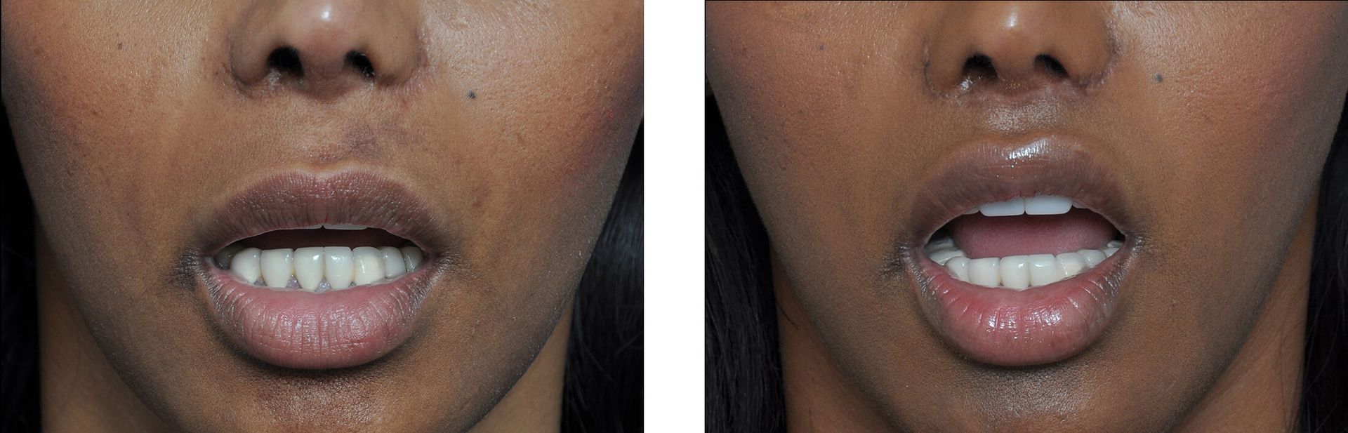 Two side-by-side images of a person's open mouth and teeth. The lips appear fuller in the right image.