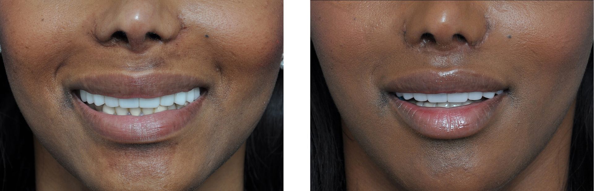Before and after photos of a person's smile. The 