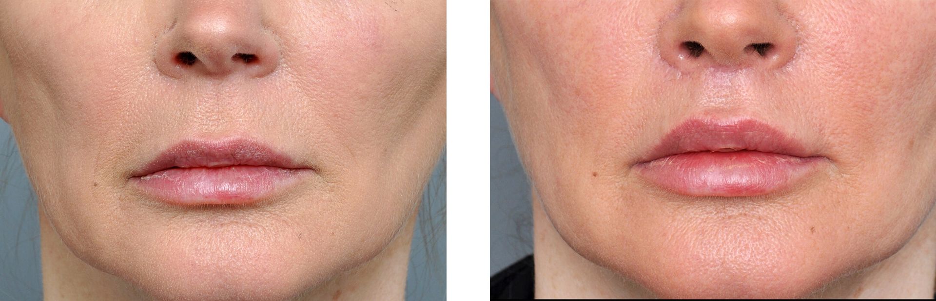 Before and after comparison of lip filler, showing enhanced lip volume.