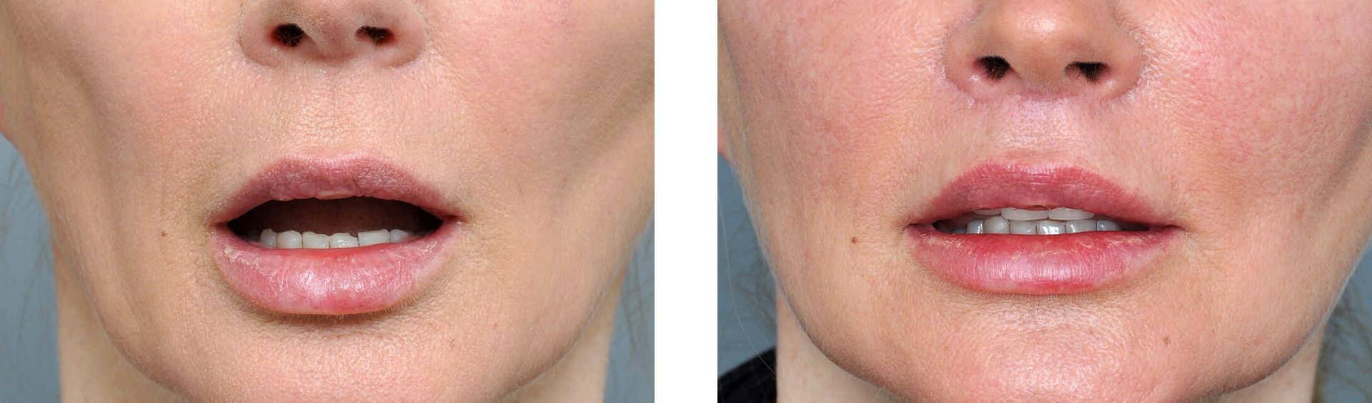 Two close-up photos of a person's lower face and mouth, before and after a lip procedure.