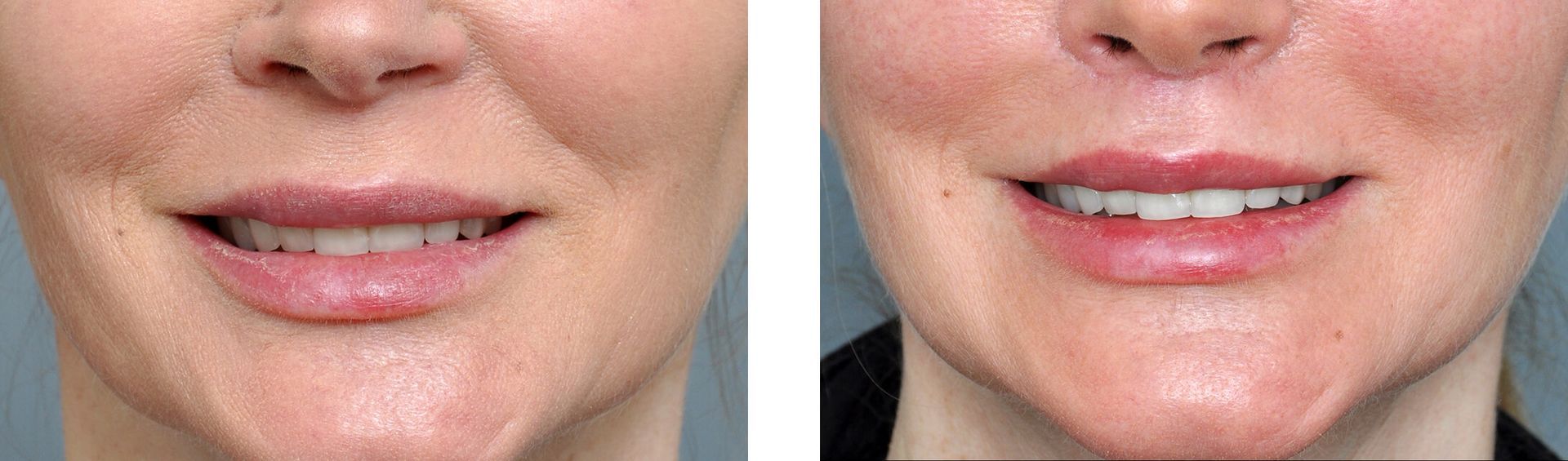 Side-by-side photos of a person's mouth before and after a procedure, showing lip fullness and reduced lines.