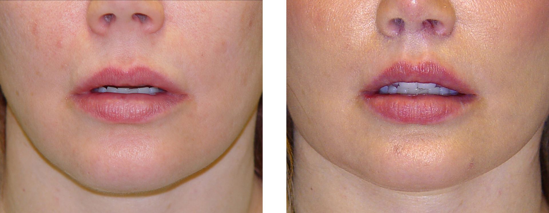 Comparison of a person's lips before and after a procedure; lips appear fuller and pinker in the 