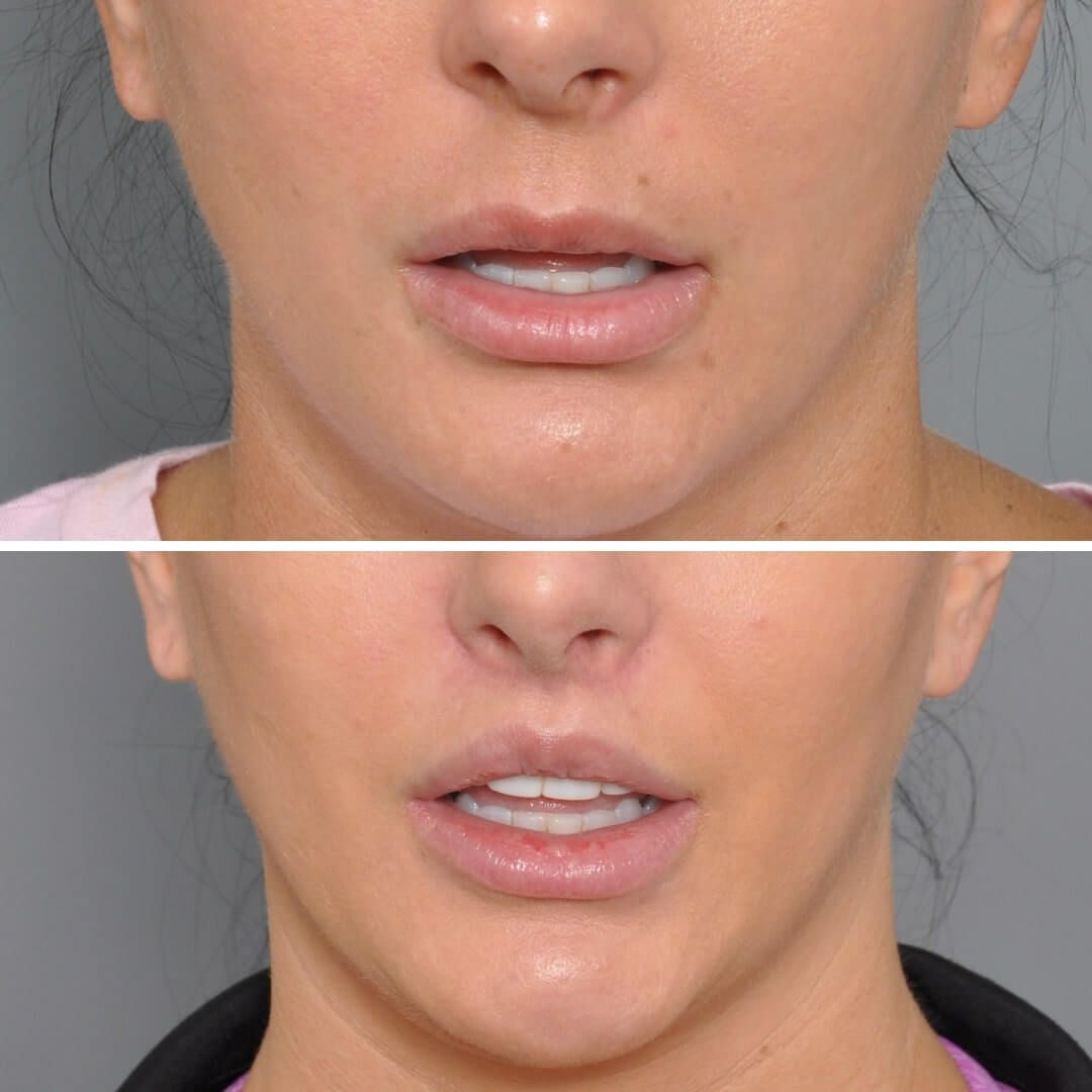 Side-by-side view: woman's lips before and after lip augmentation, showing increased fullness and shape.