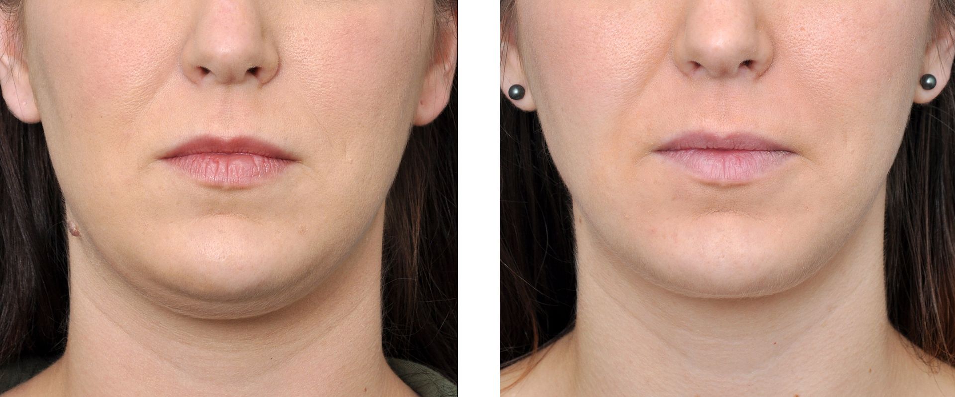 before and after facial liposuction in baton rouge
