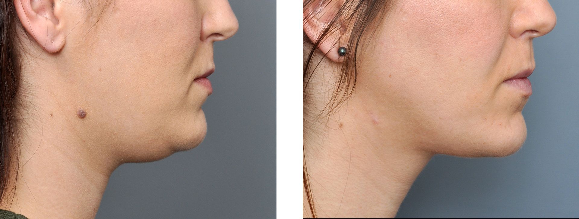 before and after facial liposuction
