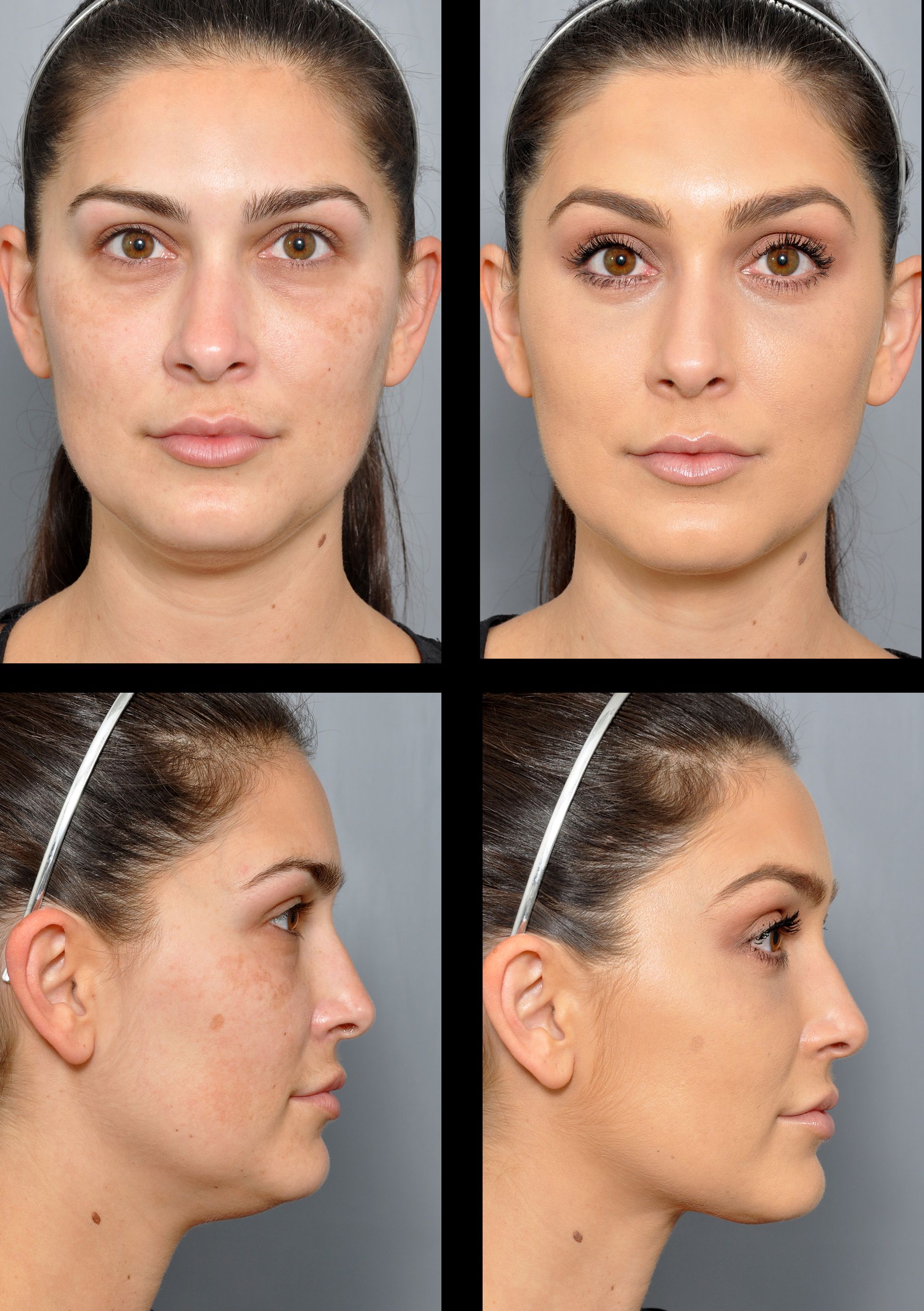 before and after image of facial liposuction