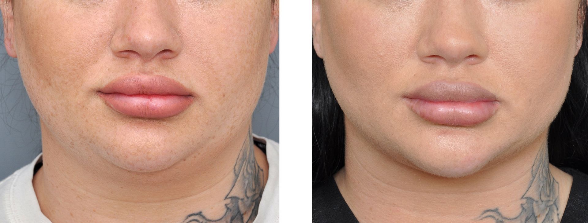 before and after facial liposcution