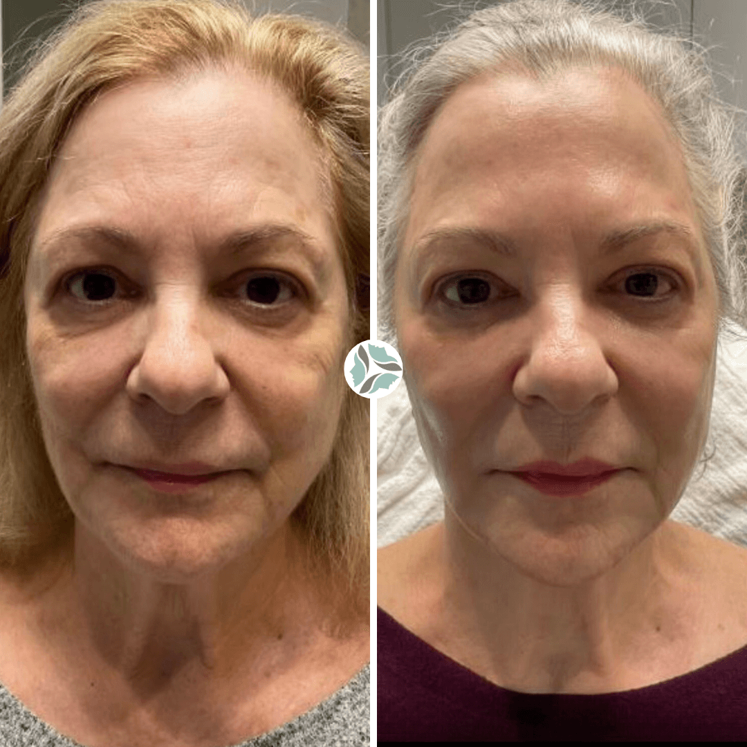 Side-by-side comparison of a person's face before and after a cosmetic procedure, showing smoother skin.