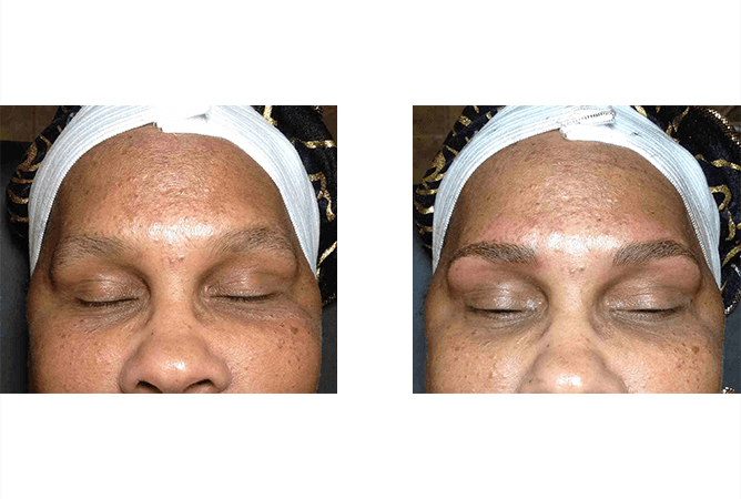 Before and after comparison of brow treatment on a person with eyes closed.