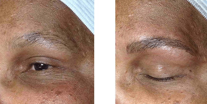 Comparison of an eyebrow before and after a cosmetic procedure; the right eyebrow appears fuller and defined.