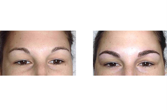 Before and after view of eyebrows: before, sparse; after, filled-in with permanent makeup, darker brown.