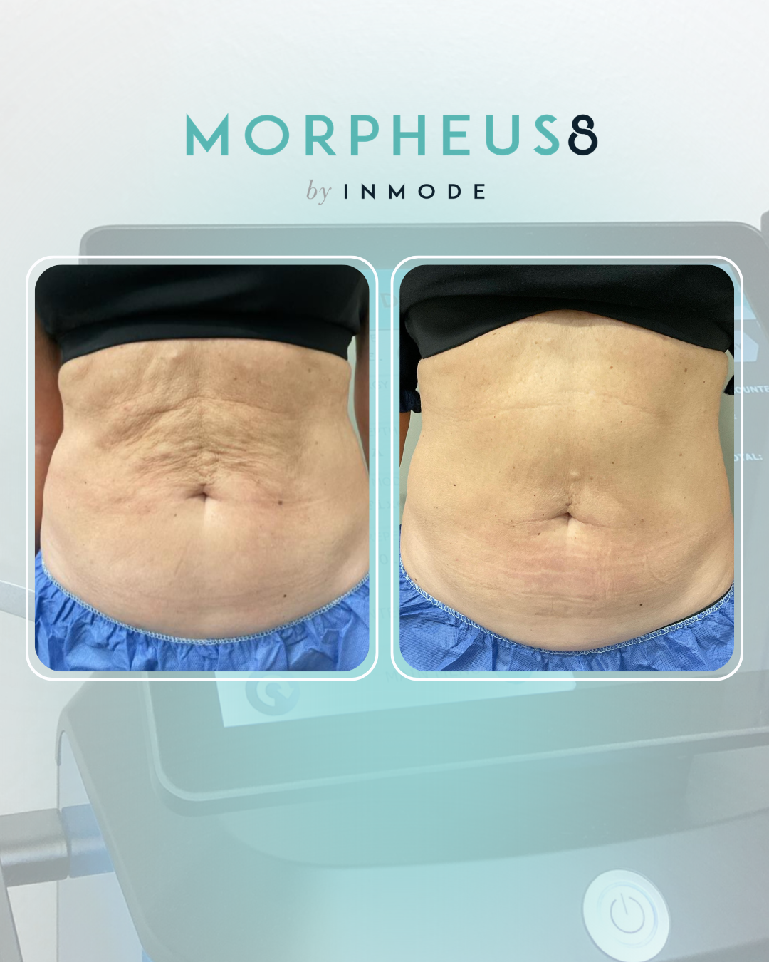 Morpheus8 treatment by Williamson Cosmetic Center & Perenack Aesthetic Surgery in Louisiana.