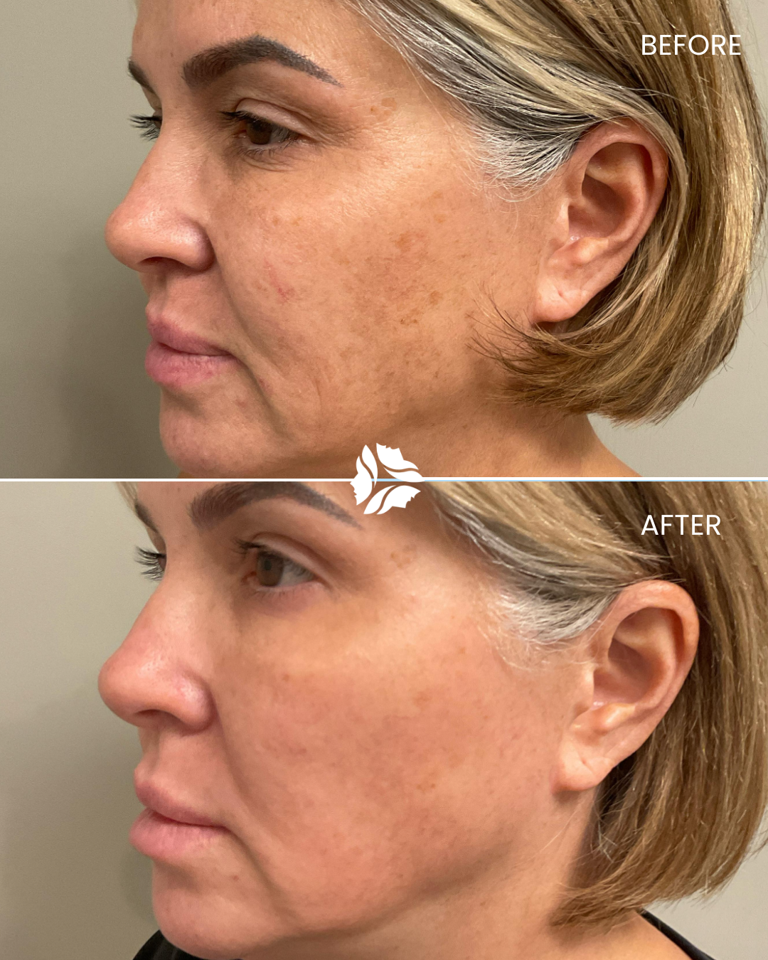 Laser treatment by Williamson Cosmetic Center & Perenack Aesthetic Surgery