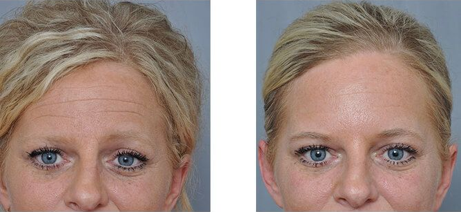 Botox from the experts at Williamson Cosmetic Center in Louisiana