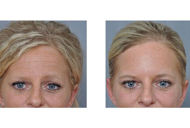 Forehead wrinkle reduction comparison: Woman with wrinkles before and smooth skin after treatment.