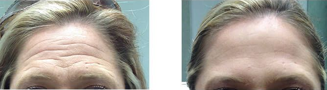 Botox from the experts at Williamson Cosmetic Center in Louisiana