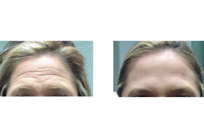Before and after comparison of a woman's forehead, showing reduction of wrinkles after treatment.