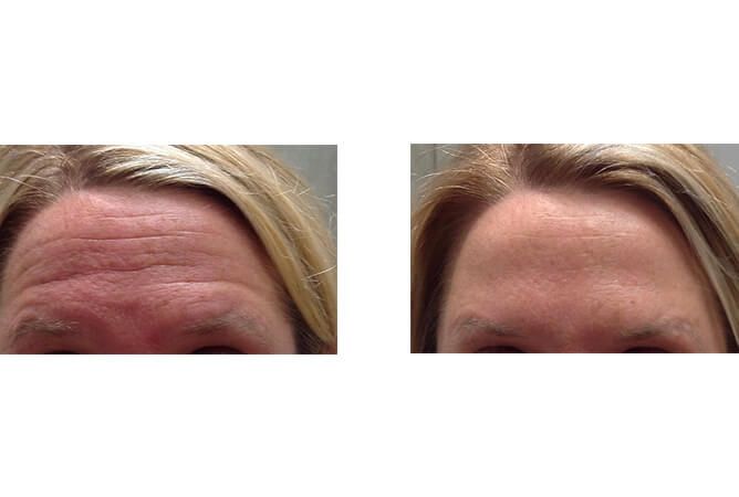 Forehead before and after treatment, showing reduction of wrinkles, blonde hair.