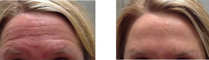 Botox from the experts at Williamson Cosmetic Center in Louisiana