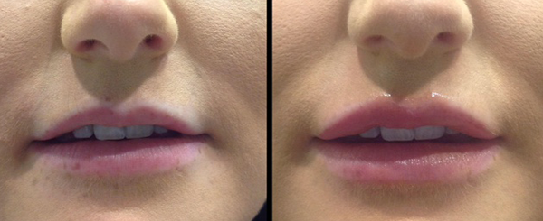 Before and after comparison of lips; the 