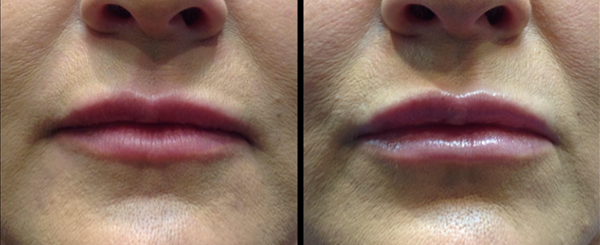 Before and after photo of lips, showing a noticeable change in size and fullness.