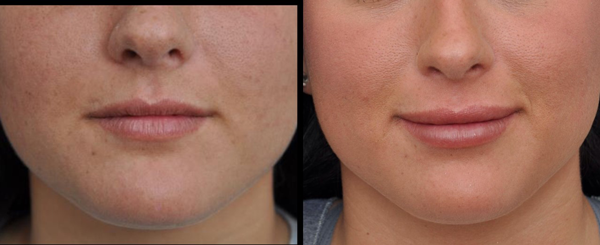Before and after lip enhancement. Left shows thin lips. Right shows fuller lips.