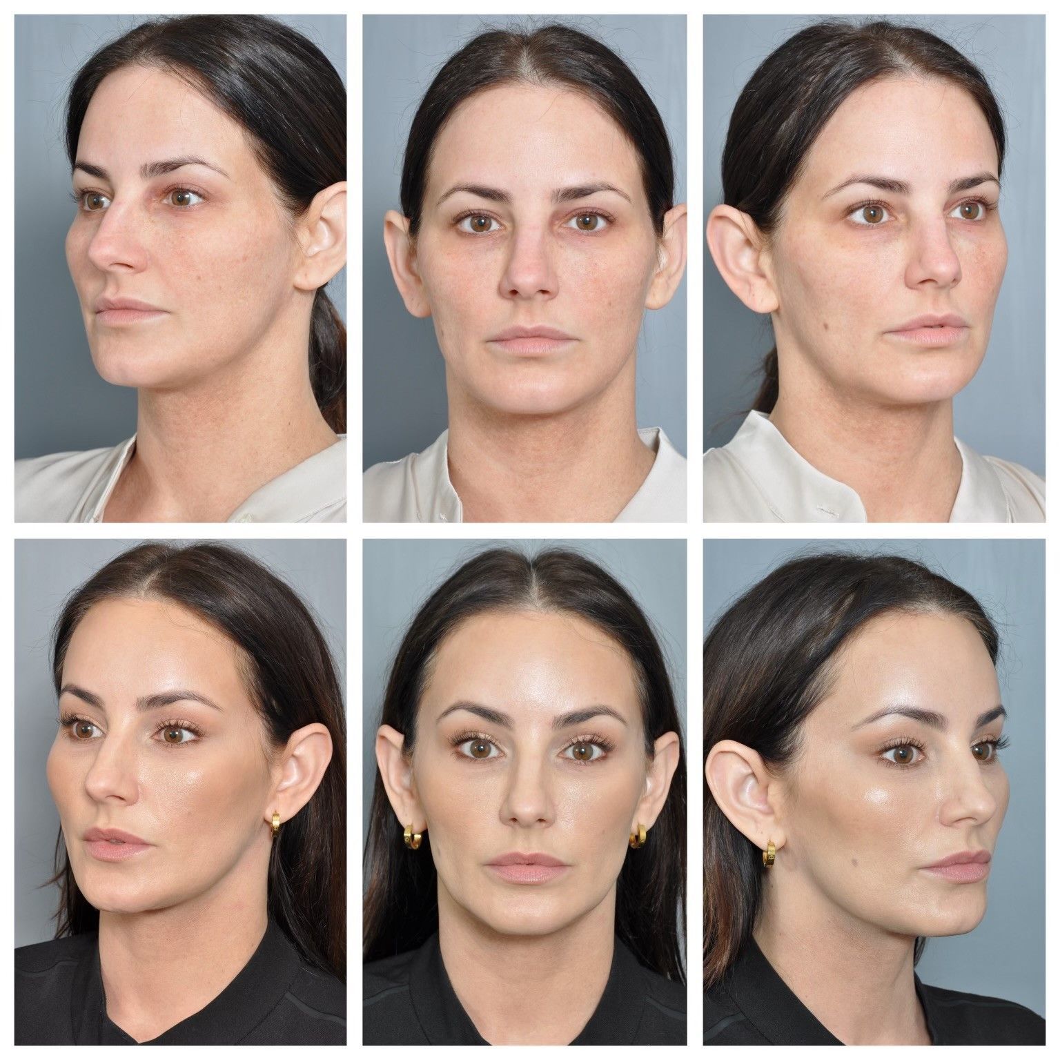 before and after eye brow lift and cheek lift 