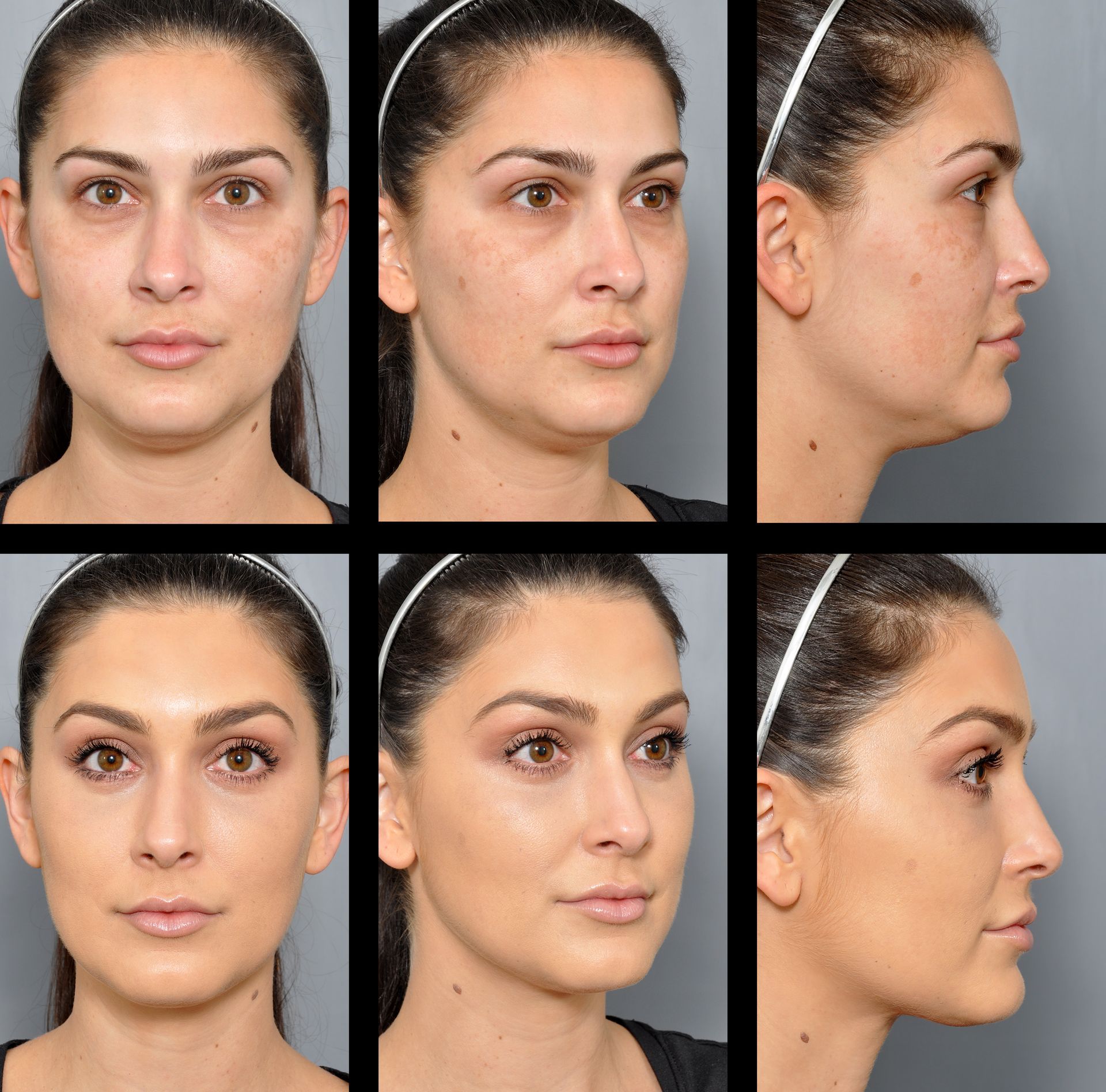 lower blepharoplasty before and after 