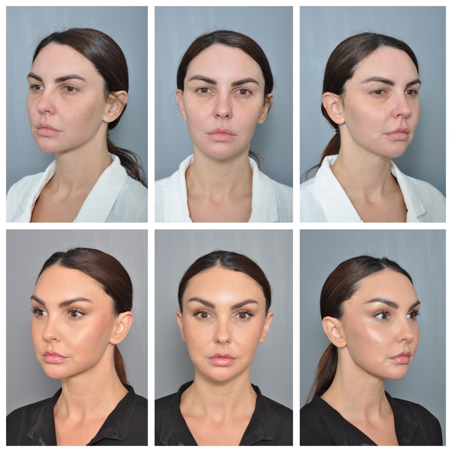 before and after eye brow lift and cheek lift 
