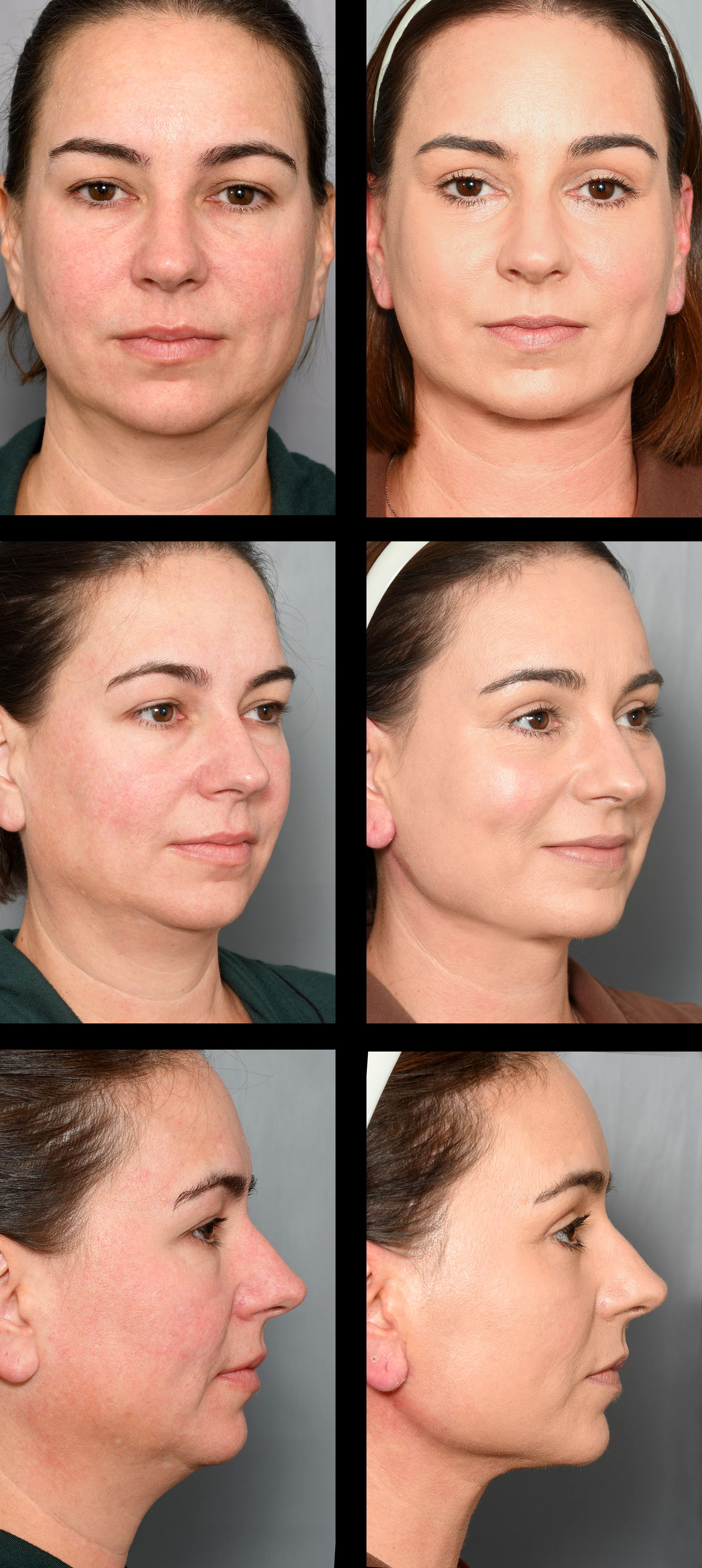 before and after lower blepharoplasty