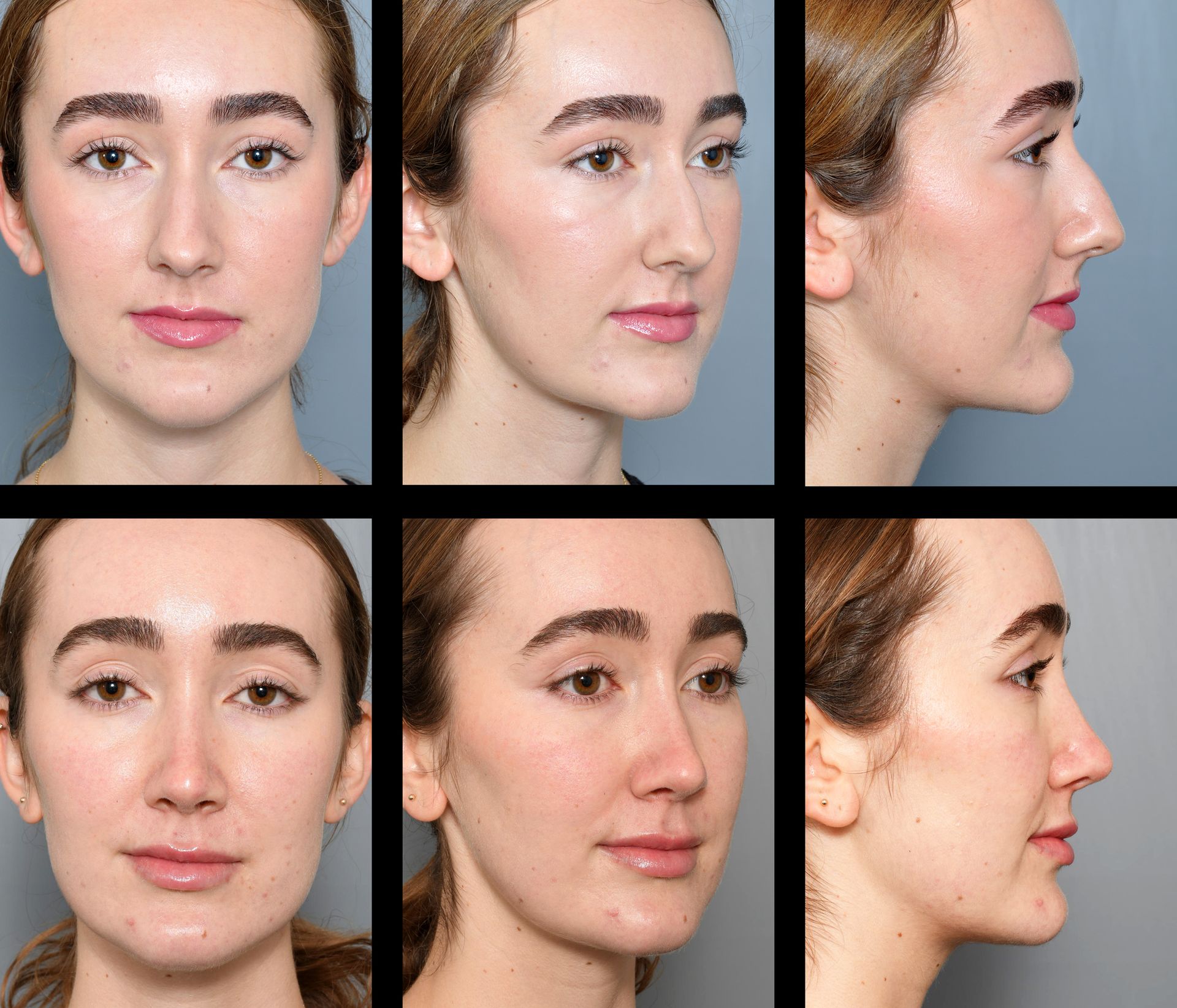 before and after rhinoplasty in baton rouge 