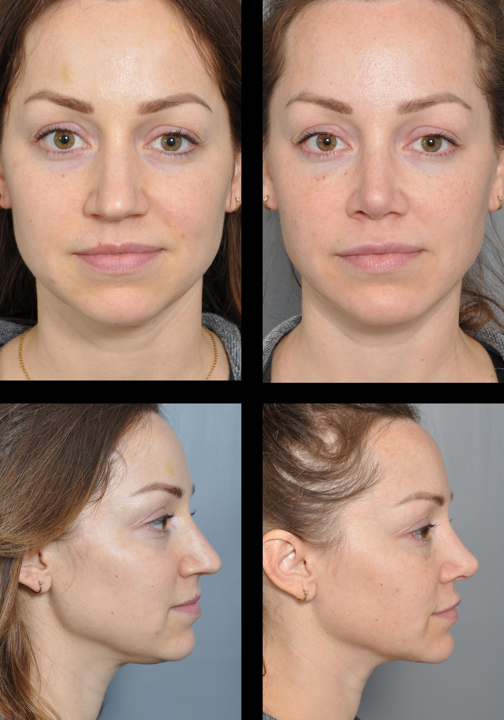 before and after rhinoplasty and chin implant