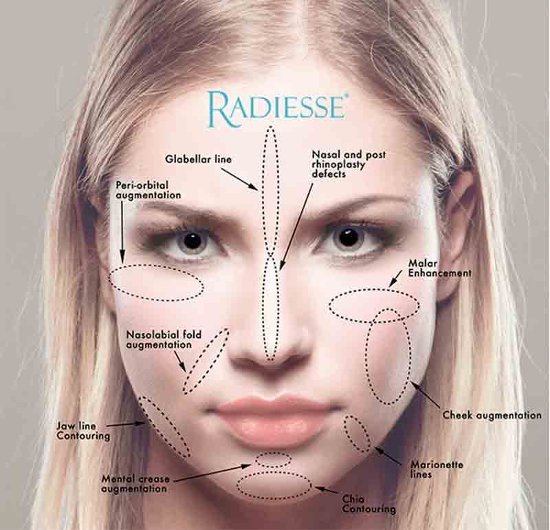 Diagram of a woman's face with dotted lines indicating areas for Radiesse injections: skin contouring, cheek augmentation.