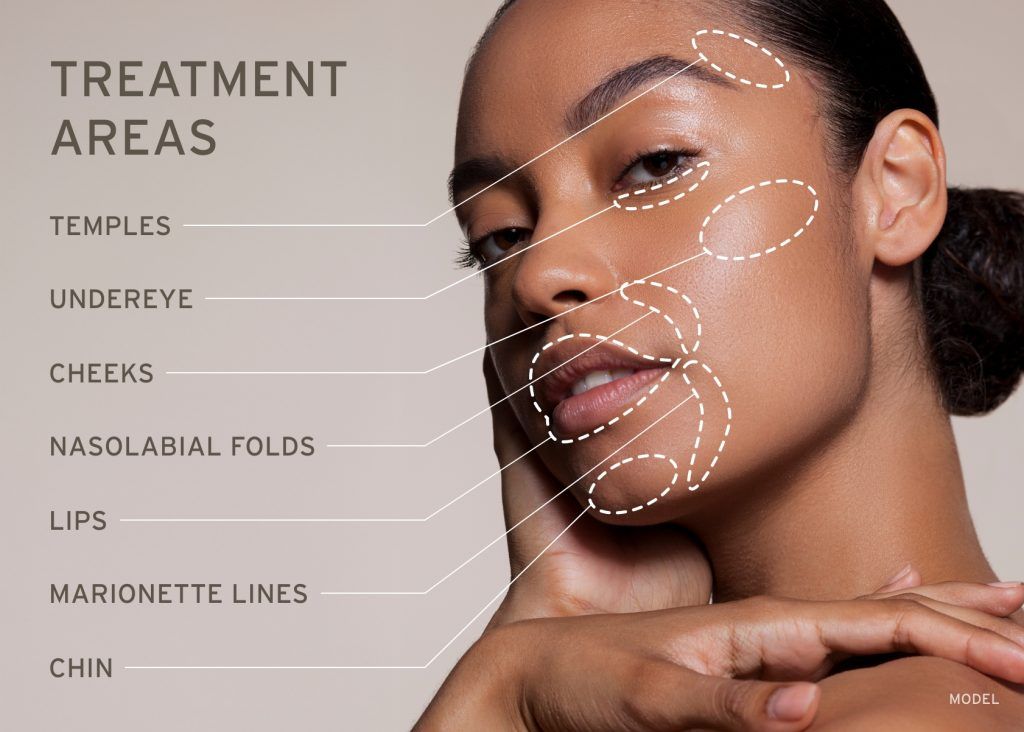 Woman's face with dotted lines indicating treatment areas: temples, under-eye, cheeks, etc.