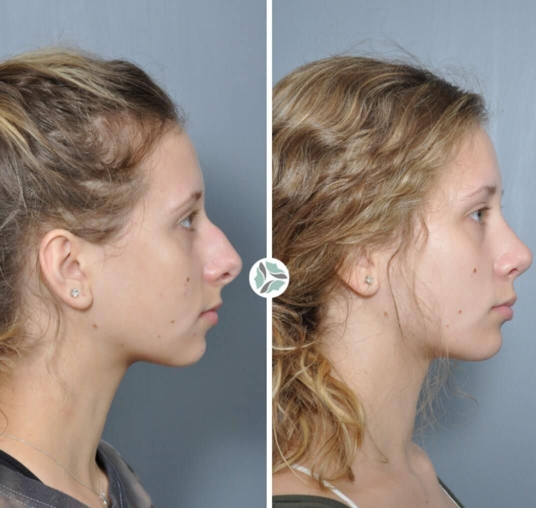 Before and after rhinoplasty showing a woman's profile; nose reshaping.