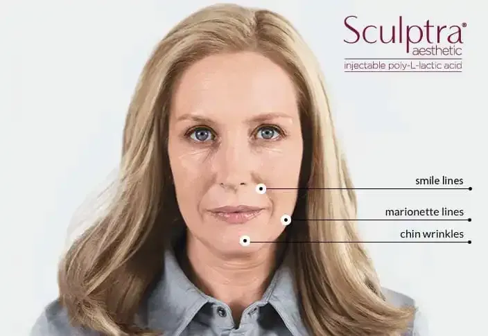 Woman's face with labeled areas for Sculptra injections: smile lines, marionette lines, and chin wrinkles.