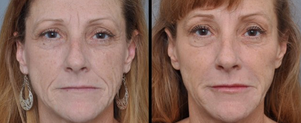 Side-by-side comparison of a person's face. Left side shows wrinkles; right side shows smoothed skin.