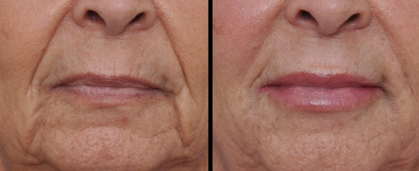 Before and after photos of a person's mouth, showing reduction in wrinkles and plumper lips.