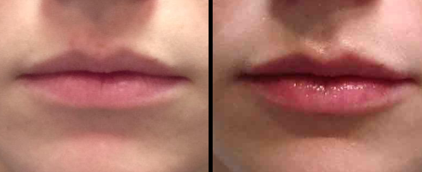 Two close-up photos side-by-side of a person's lips, before and after a treatment, lips appear plumper in the after photo.