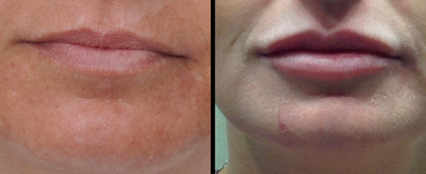 Comparison of lips before and after a procedure. The right side shows fuller lips with a more defined shape.