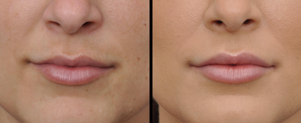 Side-by-side comparison of a person's lips. The left side is before treatment and the right side is after.
