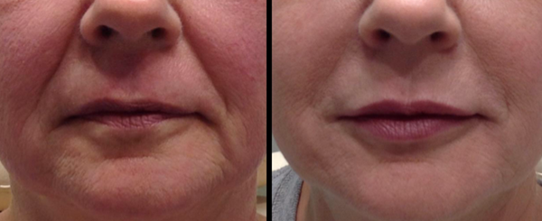 Before and after comparison of a person's lower face. The 