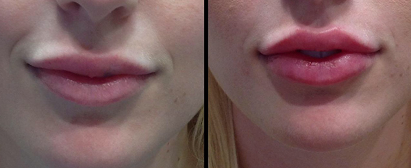 Before and after comparison of lip fillers, showing lip volume increase.