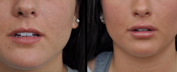 Before and after image of lips, the 